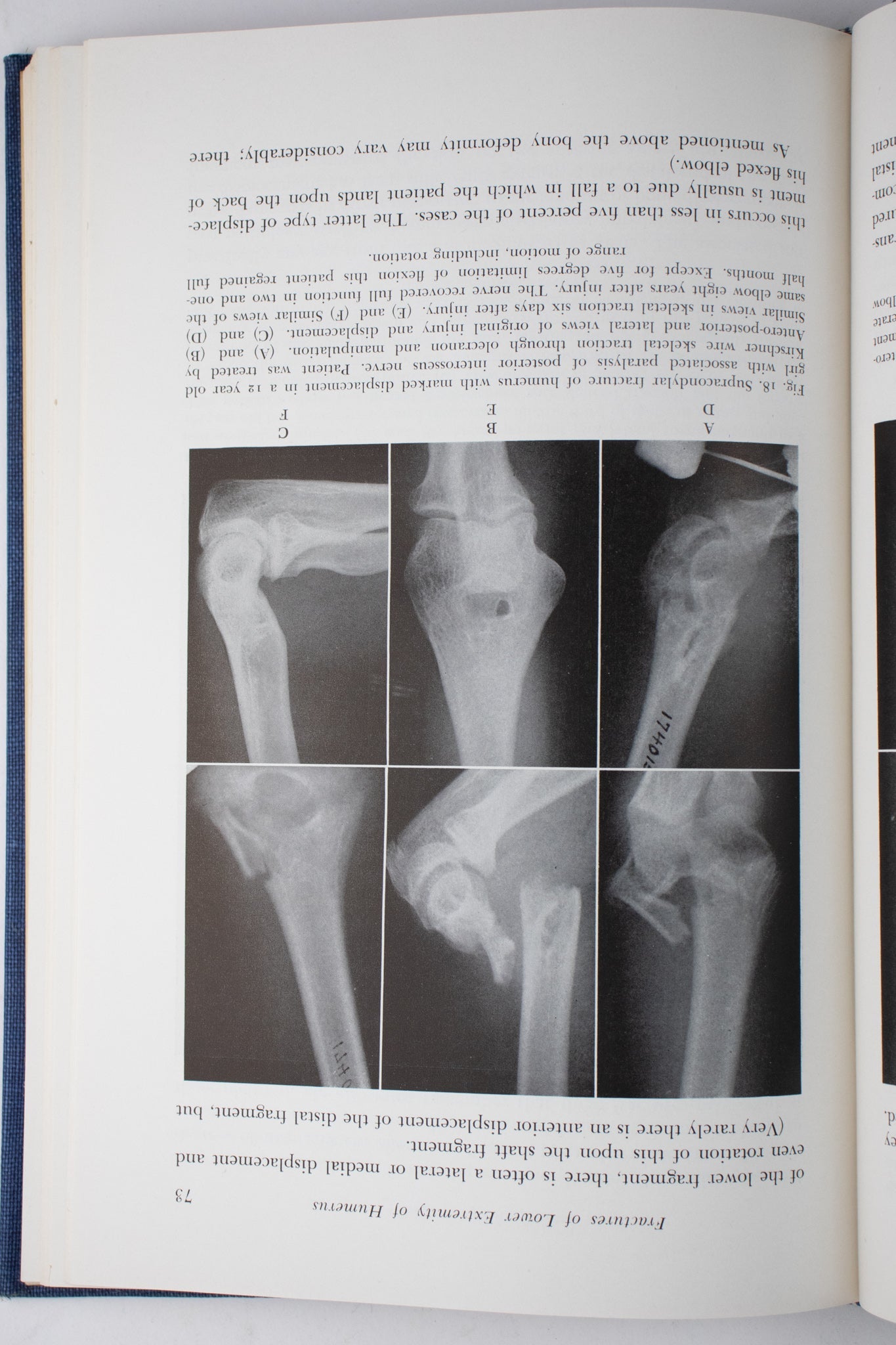 Surgery of the Elbow - Books from Stemcell Science Shop