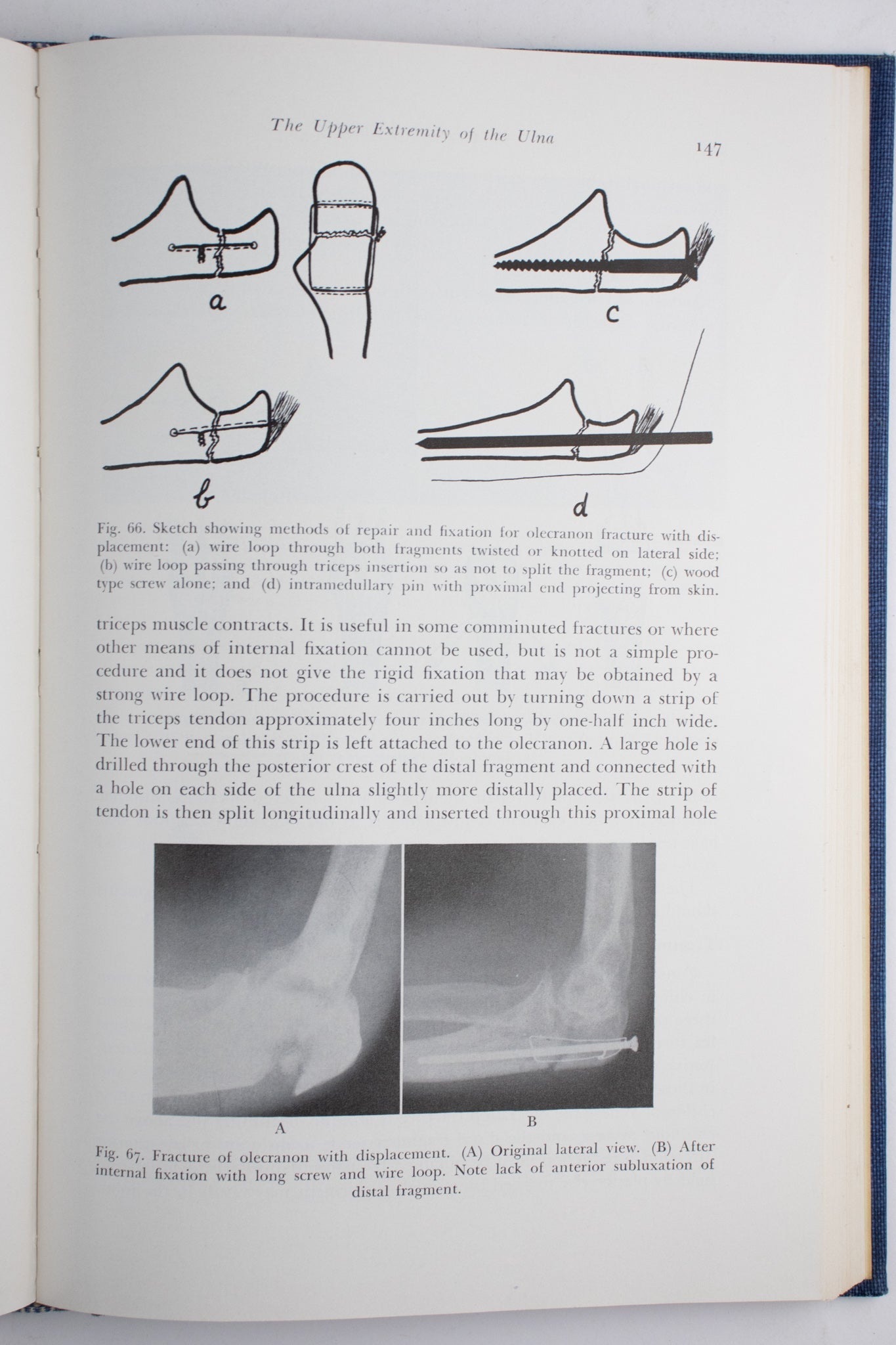 Surgery of the Elbow - Books from Stemcell Science Shop